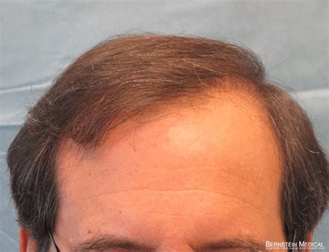 lcf hair transplant|6 Best Hair Transplant Doctors in Philippines: Reviews and Prices.